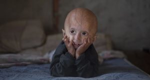 2099213_vieillissement-un-espoir-contre-la-progeria-web-tete-030420516369