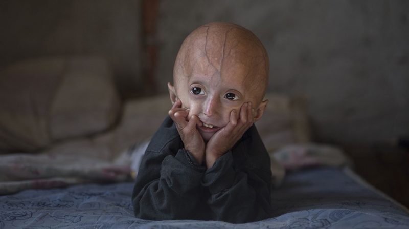 2099213_vieillissement-un-espoir-contre-la-progeria-web-tete-030420516369