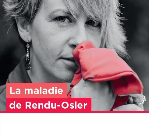 La maladie de Rendu-Osler